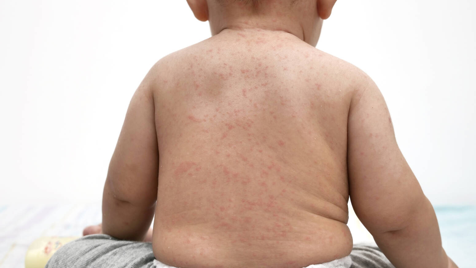 child with measles on back