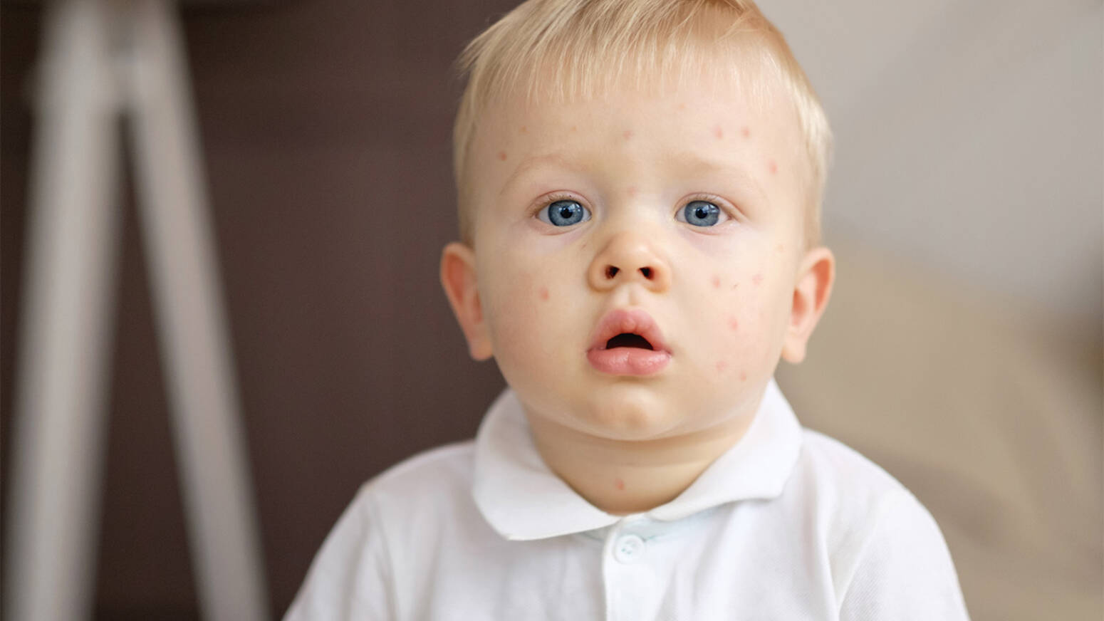 child with measles