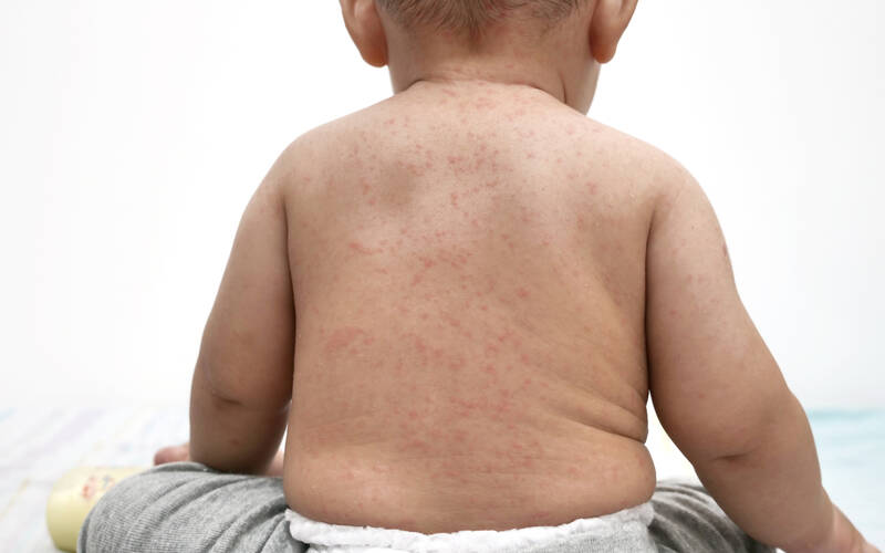 child with measles on back