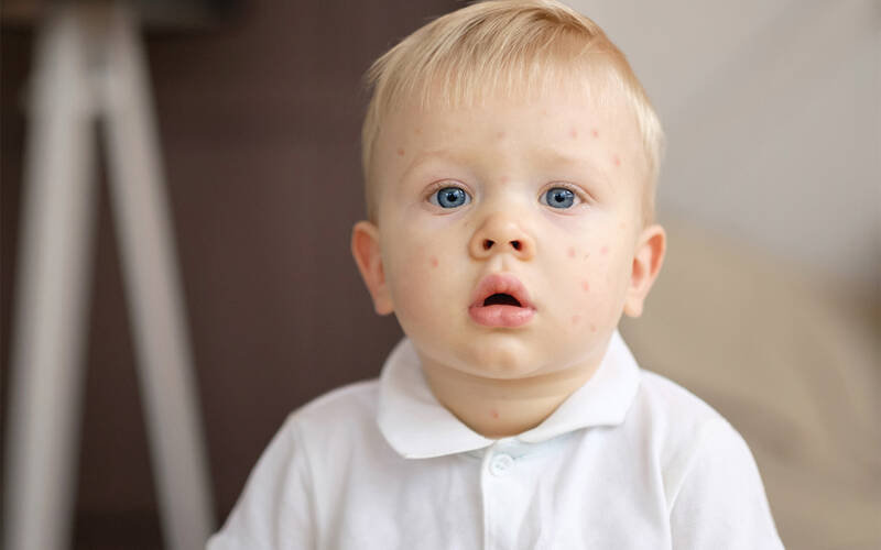 child with measles
