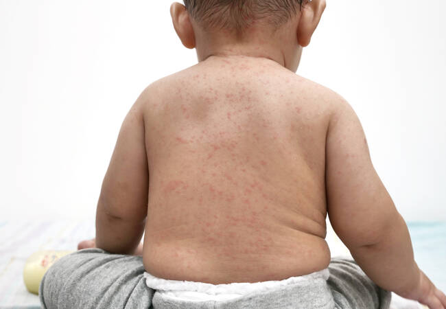 child with measles on back
