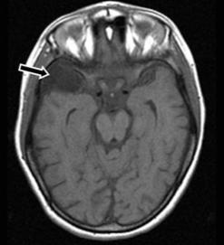 An MRI scan showing the location of an arachnoid cyst in the brain