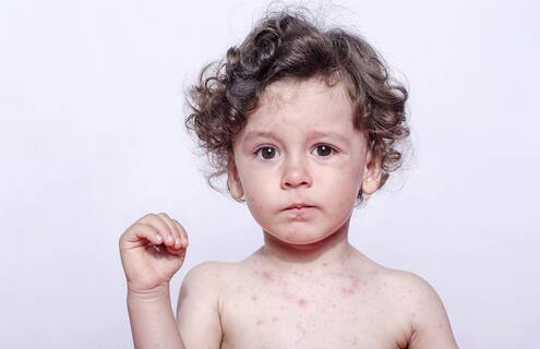 Child with measles